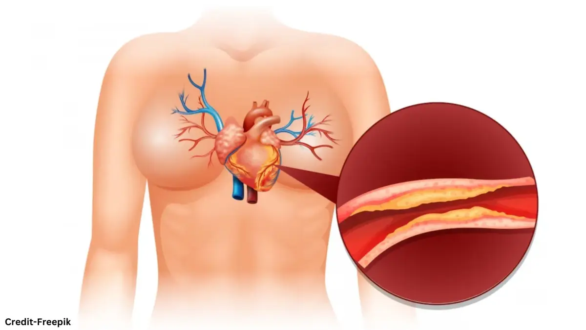 Cholesterol: शरीर में कोलेस्ट्रॉल बढ़ने के क्या लक्षण होते हैं? Cholesterol