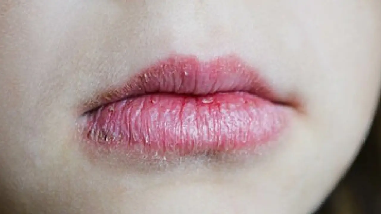 Dry and dull lips