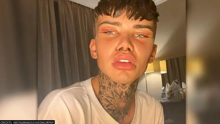 24-year-old spends more than £30,000 on plastic surgery to look like ‘Instagram filter’ 24-year-old