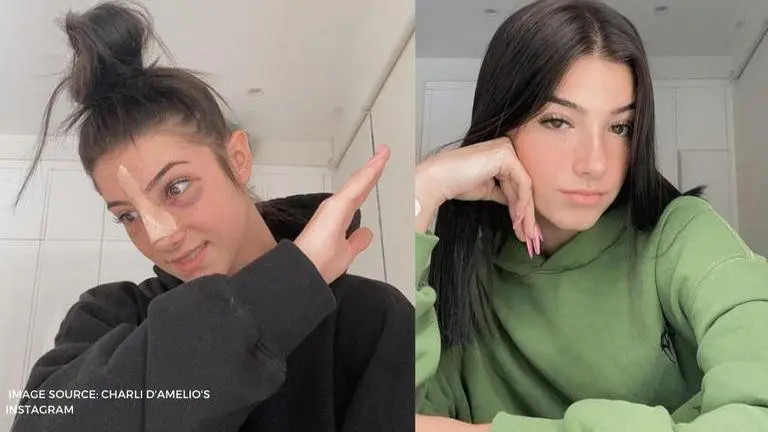 what happened to Charli D'Amelio's nose?