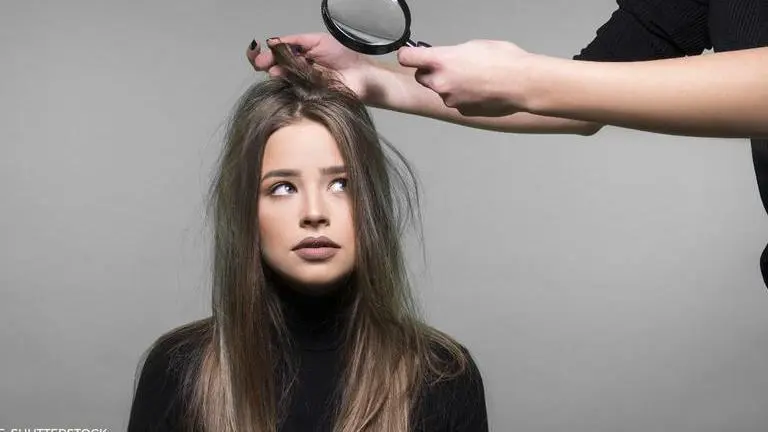 Home remedies for dandruff | Ingredients you have in your kitchen homemade solution for dandruff