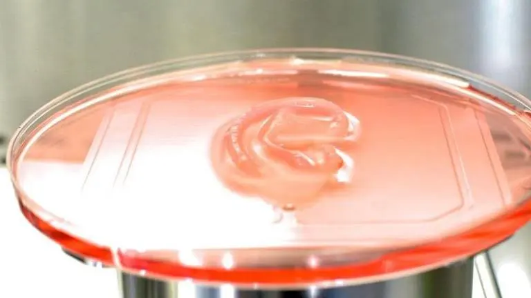 Woman born with microtia receives first-ever 3D printed ear transplant from her own cells Ear transplant