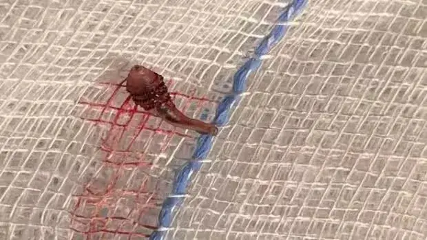 Bengaluru woman complaints of headaches, after inspection doctors found a living botfly larva Neelima's ordeal began with excruciating pain and a peculiar crawling sensation on her scalp, prompting her to seek medical attention