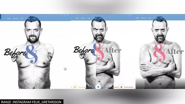 Man shares miraculous recovery journey after getting world's first double arm transplant Man