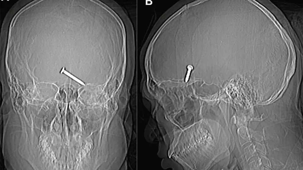 X-rays revealed the nail lodged into the man's brain after it entered through his left eye.