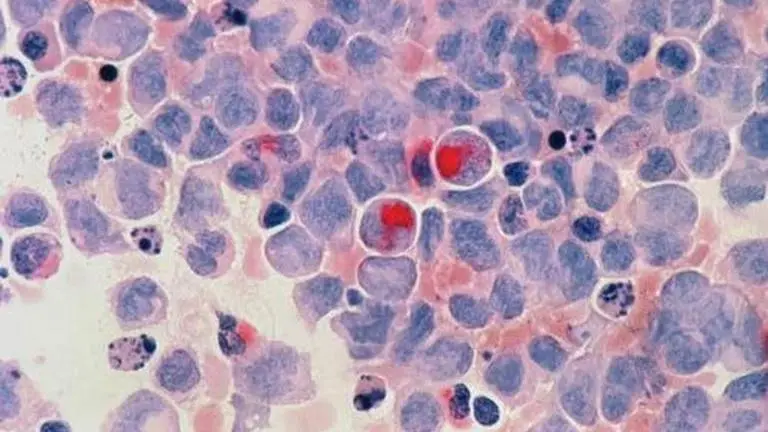 European experts develop new cancer treatment method; trial shows promising results Cancer