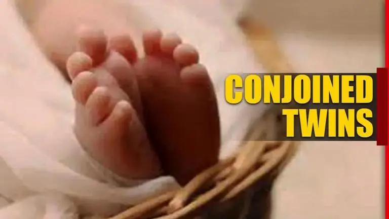 MP woman delivers ‘rare conjoined twins’ with two heads, three hands MP woman