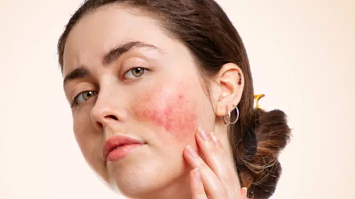 World Lupus Day 2024: Date, History, Significance And Spreading Awareness About Autoimmune Disease World Lupus Day