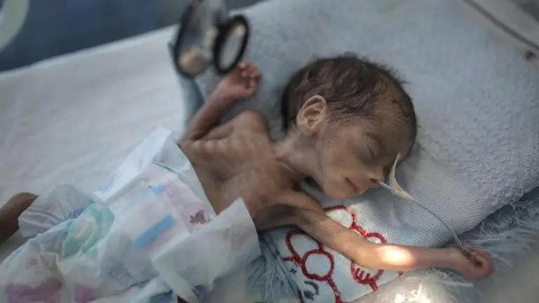 Children in Yemen suffer from severe malnutrition