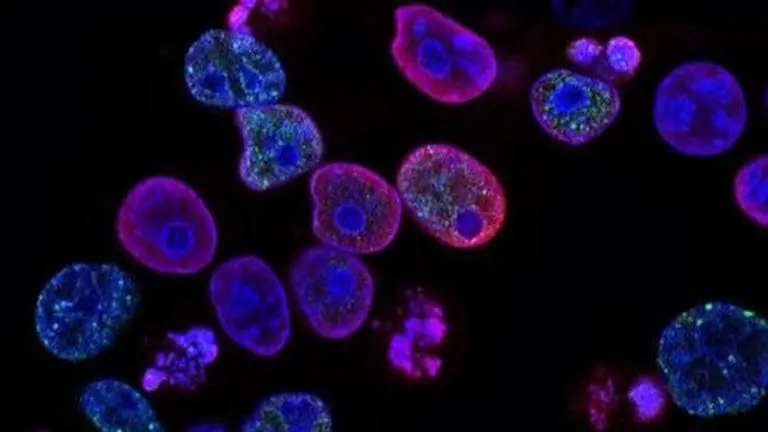 In breakthrough trial, Cancer drug makes rectal tumors disappear with 100% success Cancer