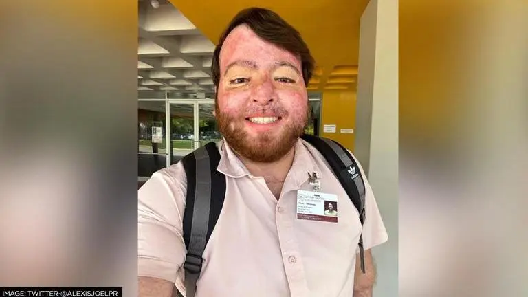Man joins med school 3 years after being severely burnt; netizens laud his spirit Viral news
