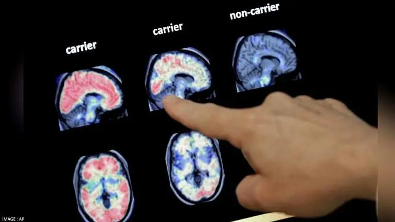 Pineapple extract may help treat Alzheimer's disease, animal study suggests Health