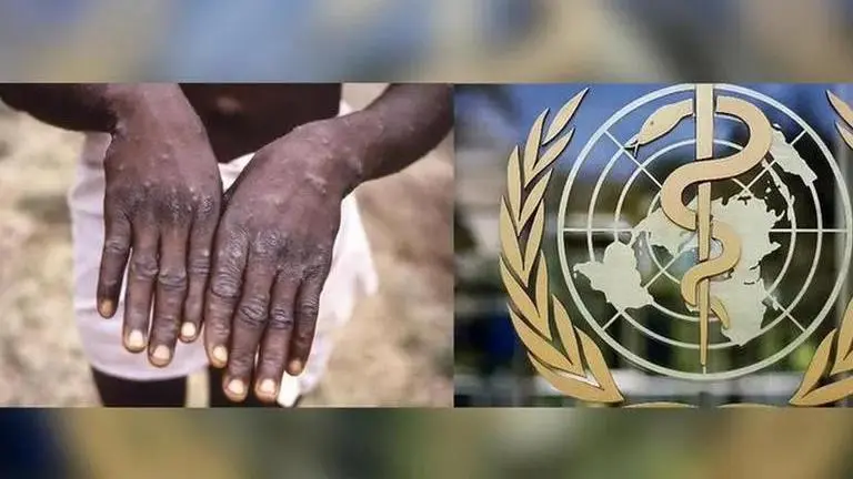 WHO says monkeypox outbreak can still be contained as risk of transmission 'low' WHO