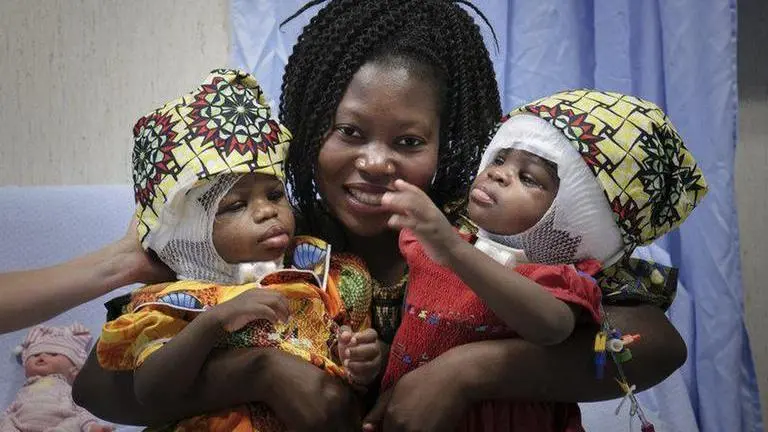 Twins joined at head separated at Vatican pediatric hospital