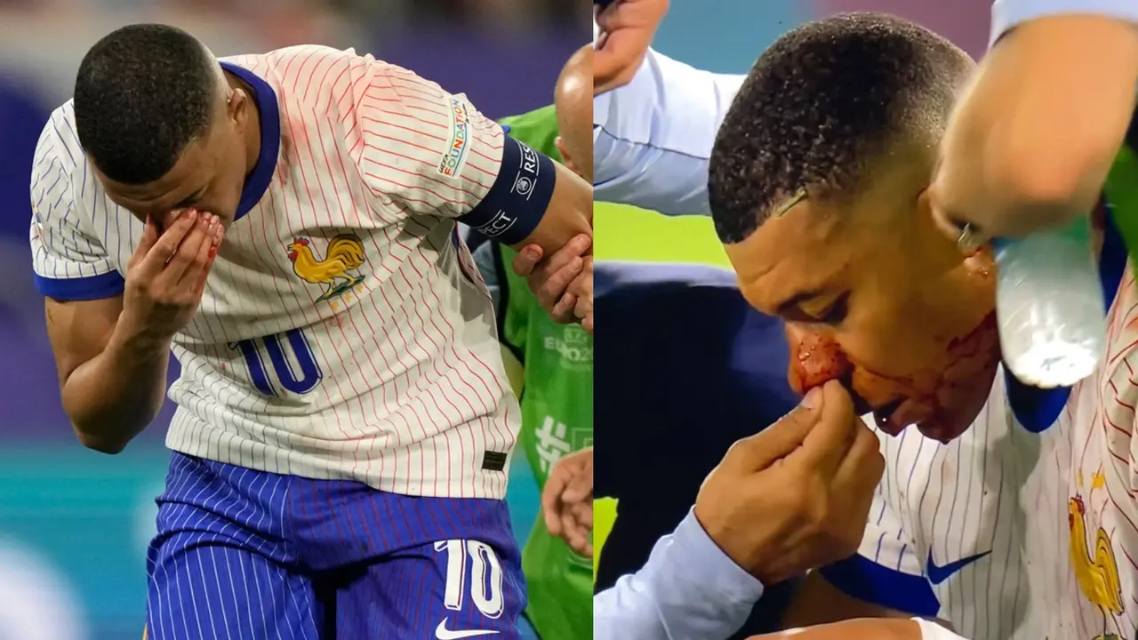 Kylian Mbappe BREAKS NOSE after HORRIFYING injury in France vs Austria at Euro 2024 Kylian Mbappe breaks nose for France vs Austria in Euro 2024