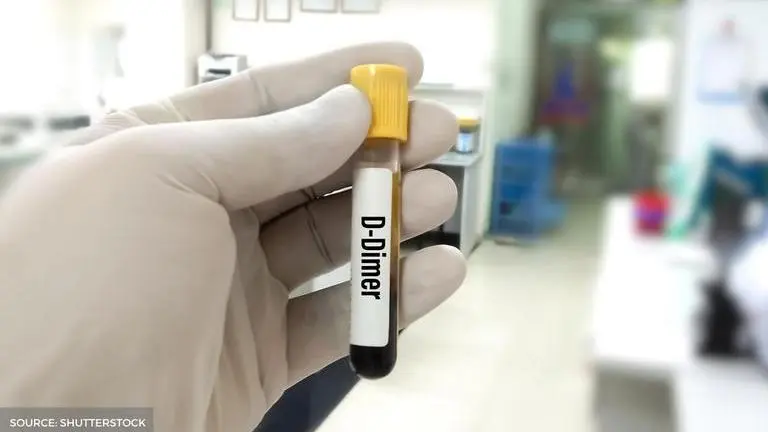 D-dimer Test: Find out what is the normal range of this protein in our bodies Image Credit: Shutterstock