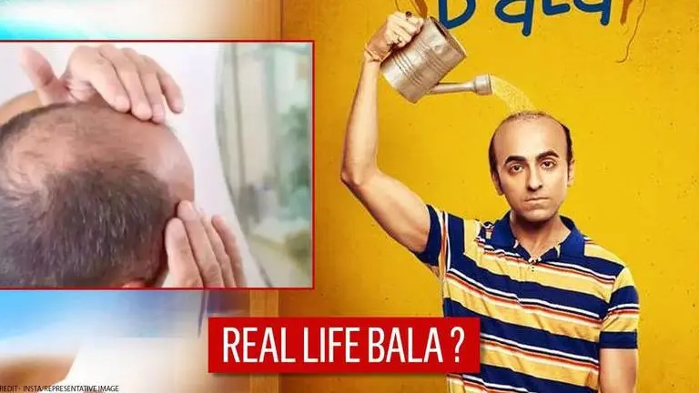 Mumbai: Woman sues husband for hiding his baldness, duping her into marriage