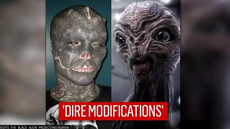 'I can walk with my head high': Man gets upper lip, nose removed to look like black alien Man gets upper lip, nose removed in bid to look like black alien