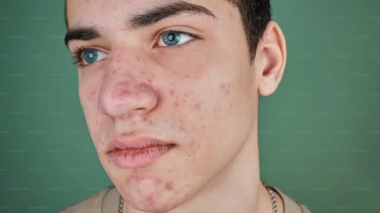 Juvenile Dermatomyositis (JDM)