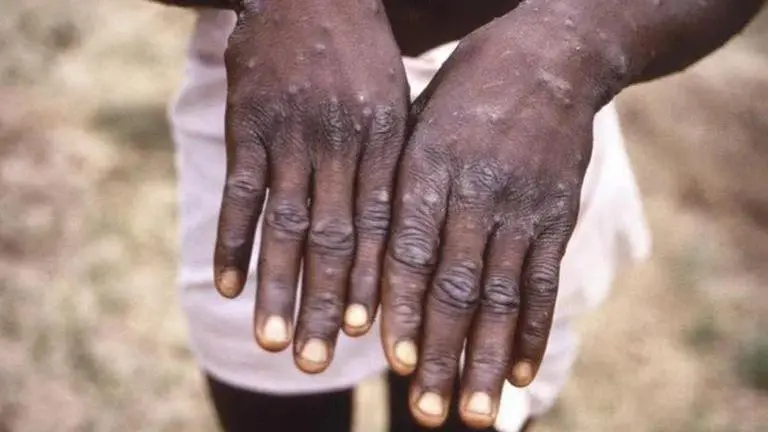 Expert: Monkeypox likely spread by sex at 2 raves in Europe Monkeypox