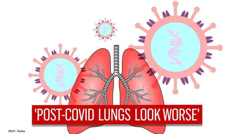 COVID-19 survivors show severe lungs in X-rays, 'far worse than any type of smokers' COVID-19