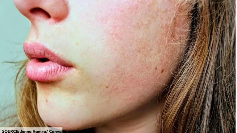 Home remedies to help you to get rid of flaky skin home remedies for skin