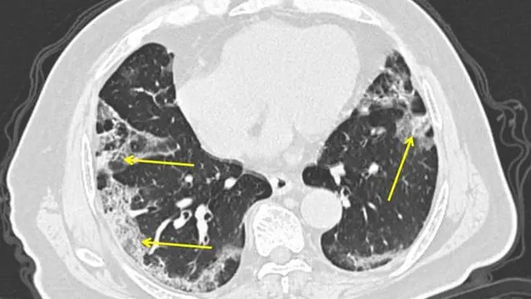 COVID-19 lung patterns show few clues for treating pneumonia