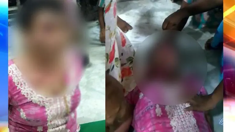 West Bengal: Transgender beaten mercilessly, burnt by community members after quarrel West Bengal transgender beaten