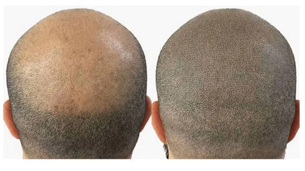 BrowMaster launches scalp micropigmentation training courses in India BrowMaster