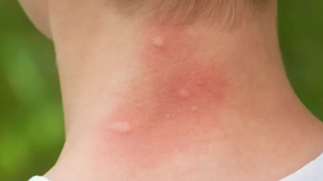 Precautionary Measures Against Mosquito Attacks During Summers Mosquito bites
