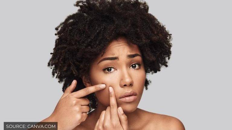 How to reduce acne? A quick measure guide to solve the problem at home ...