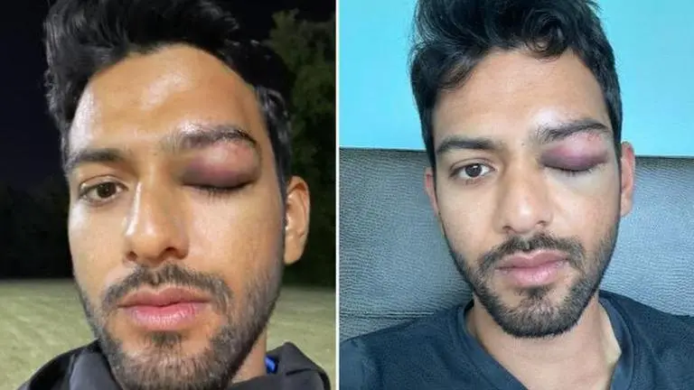 Unmukt Chand's bruised eye picture is getting fans worried: 'Survived a possible disaster' Unmukt Chand, Cricket news, Indian cricket, Unmukt chand cricket, Where is unmukt chand, Unmukt Chand injury, Unmukt Chand, Unmukt Chand career