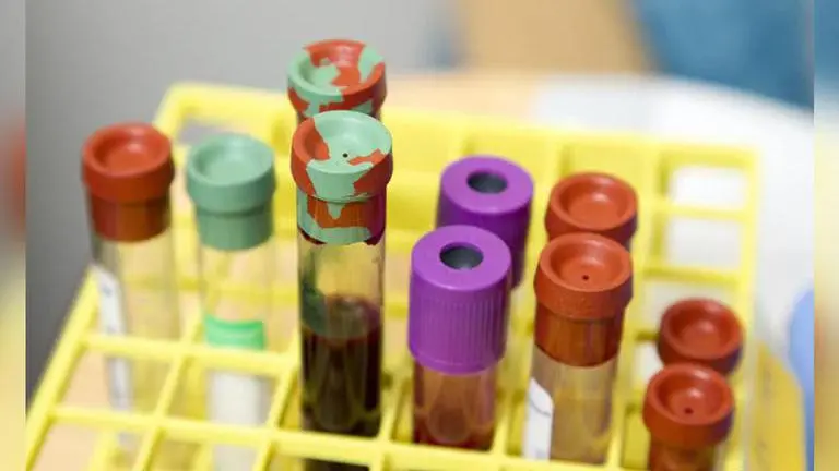 Blood clotting may contribute to long COVID pathogenesis: Study COVID-19