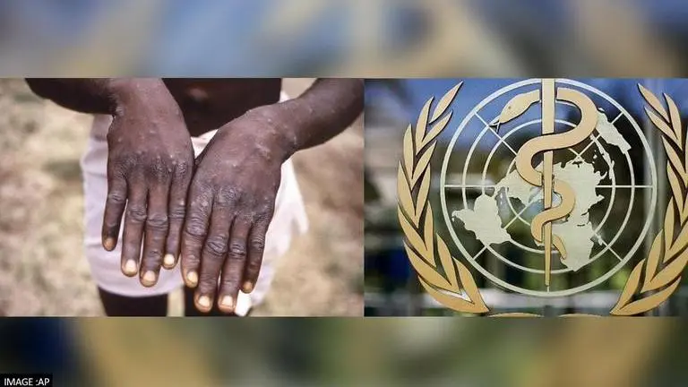 WHO confirms 80 cases of monkeypox in 11 countries, says 50 investigations 'pending' WHO