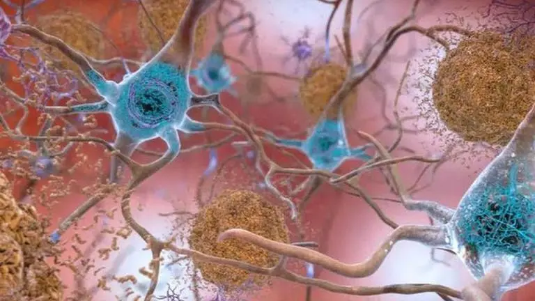 19-yr-old in China dies due to Alzheimer's, reseachers claim he was youngest patient ever China