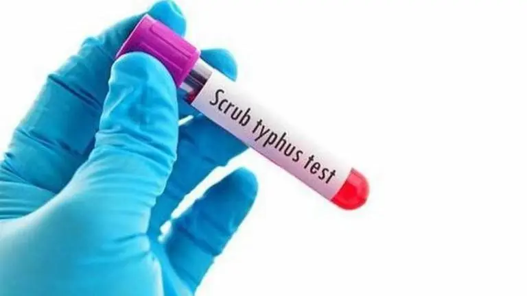 Scrub Typhus in Kerala: What is Scrub typhus? Symptoms & treatment; All you must Know Scrub typhus