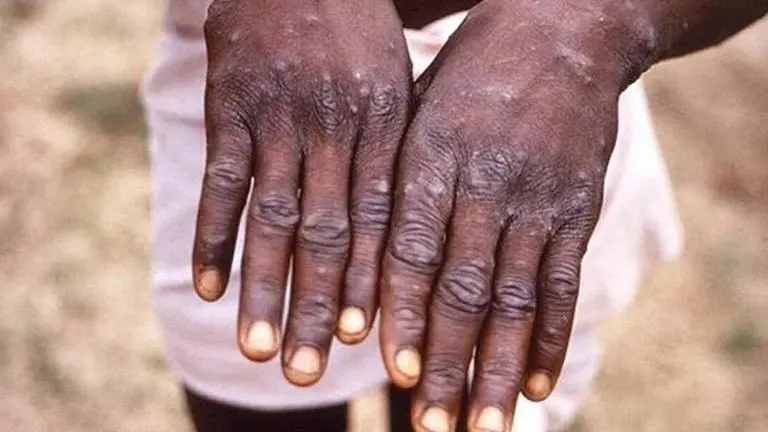 Big relief: No monkeypox in India after negative result for suspected Ghaziabad case Monkeypox