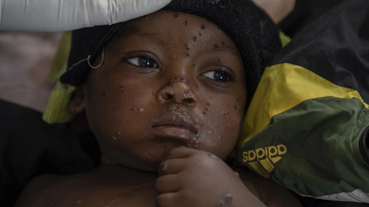 A two-year-old Mpox patient lying in the epicentre of this viral disease in Congo.