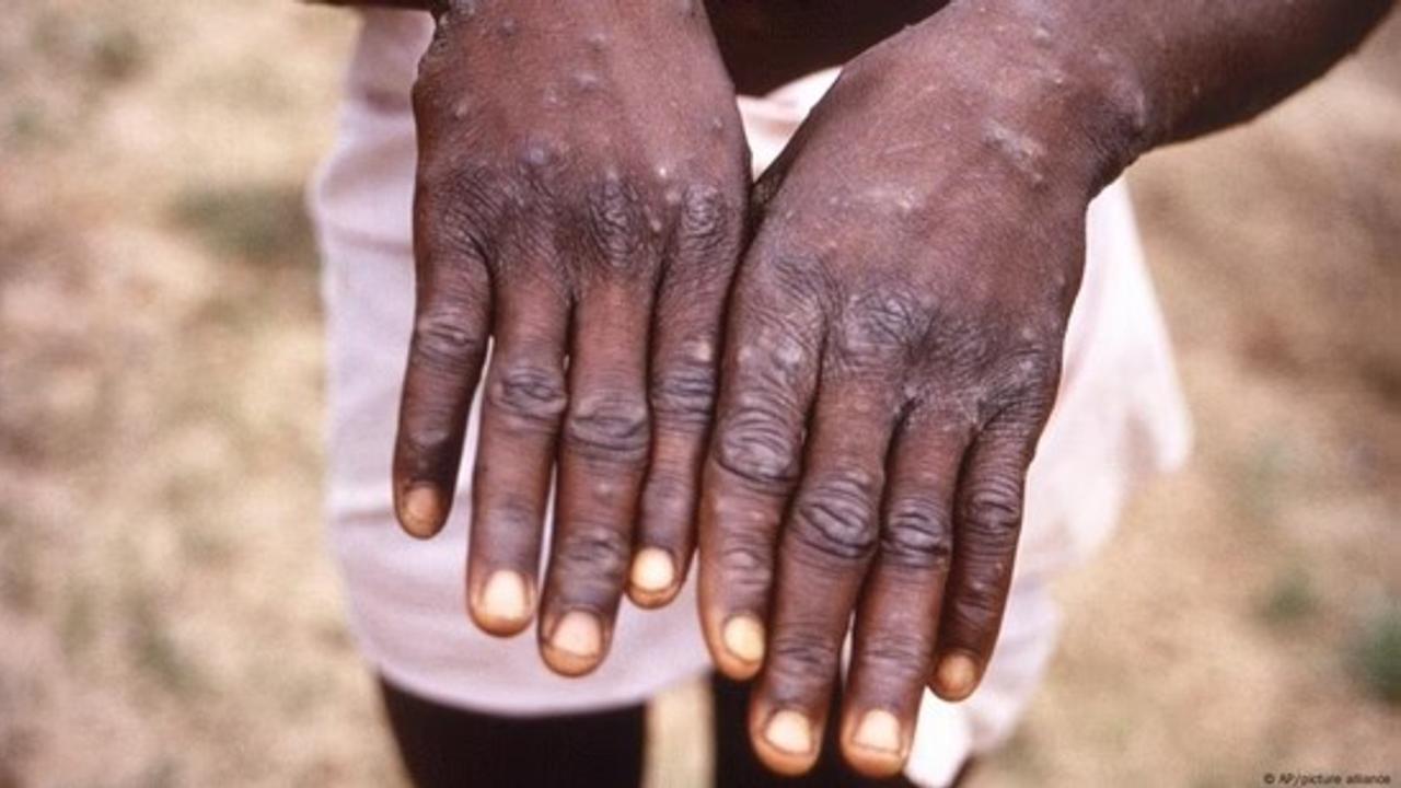 monkeypox virus, Mpox cases, ,mpox clade 1 symptoms