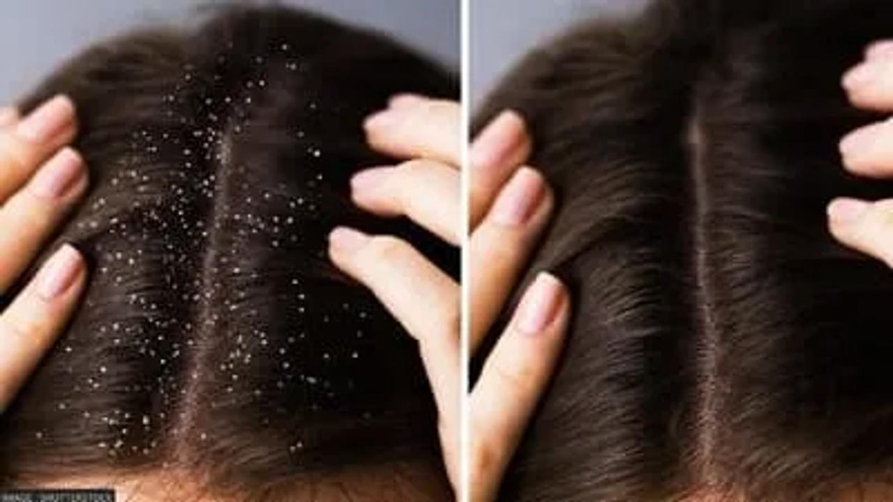 Dandruff