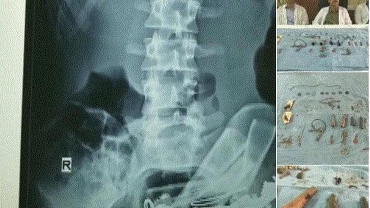 Atypical: 80 objects including keys, chains removed from man's stomach in a span of 90 minutes