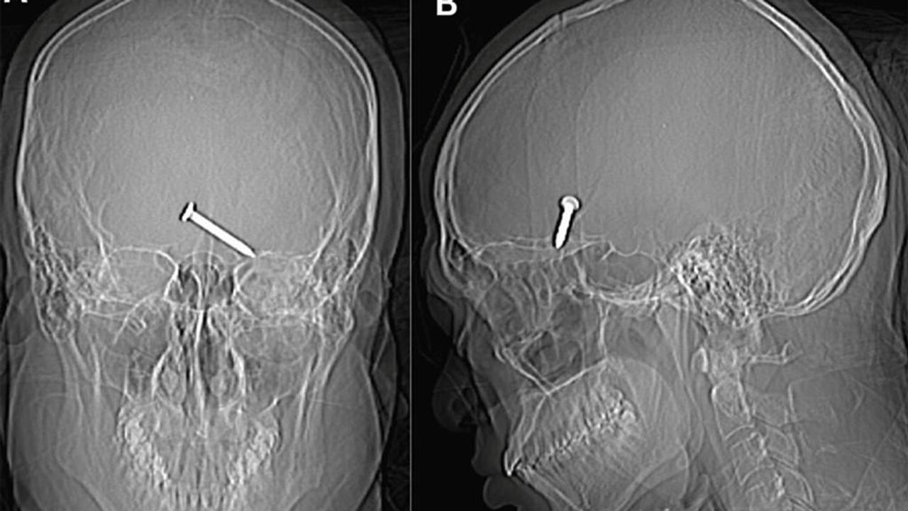 X-rays revealed the nail lodged into the man's brain after it entered through his left eye.