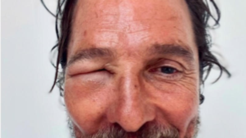 Matthew McConaughey  Stung By Bee