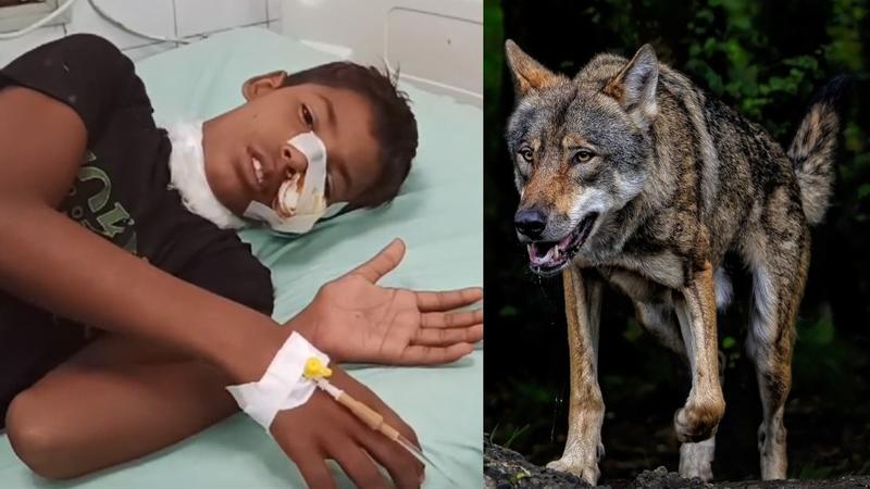 child-injured-bahraich-wolf-attack