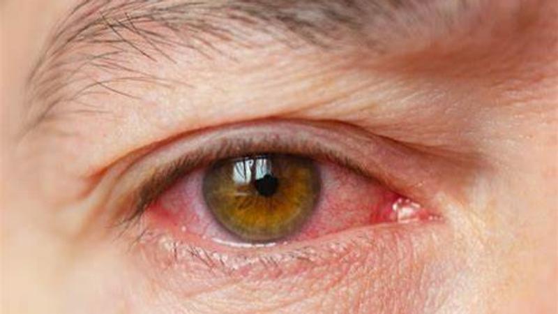 Conjunctivitis aka pink eye is considered a seasonal disease.