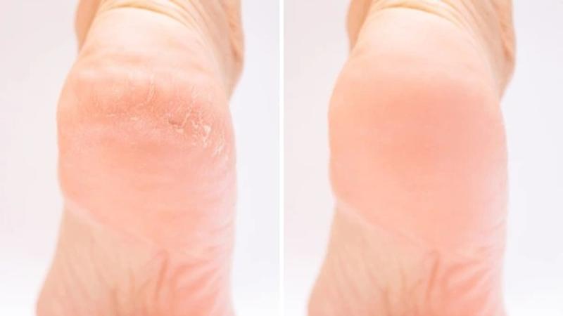 What does cracked feet indicate about your liver health?