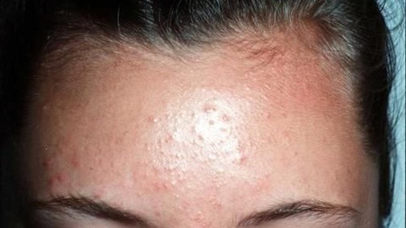 Causes of forehead acne