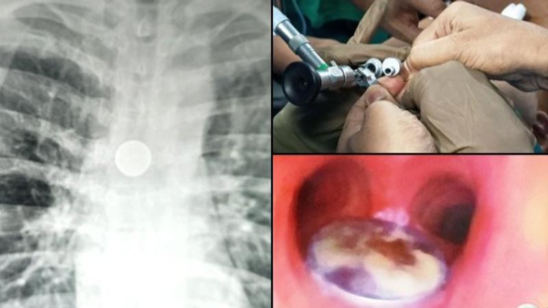 BHU Doctors Remove 25 Paise Coin from Patient's Windpipe 