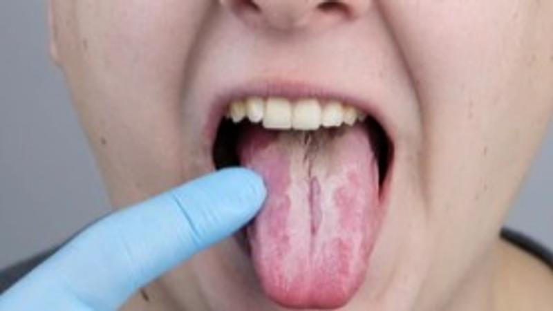 Oral Thrush