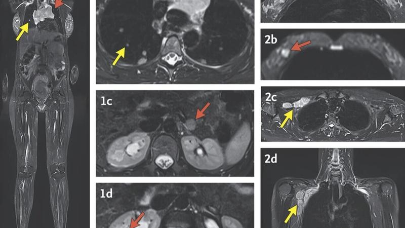 These MRI images with arrows indicating cancer were made during a study by researchers at the National Institutes of Health and published Wednesday, Dec. 4, 2024, in the New England Journal of Medicine.